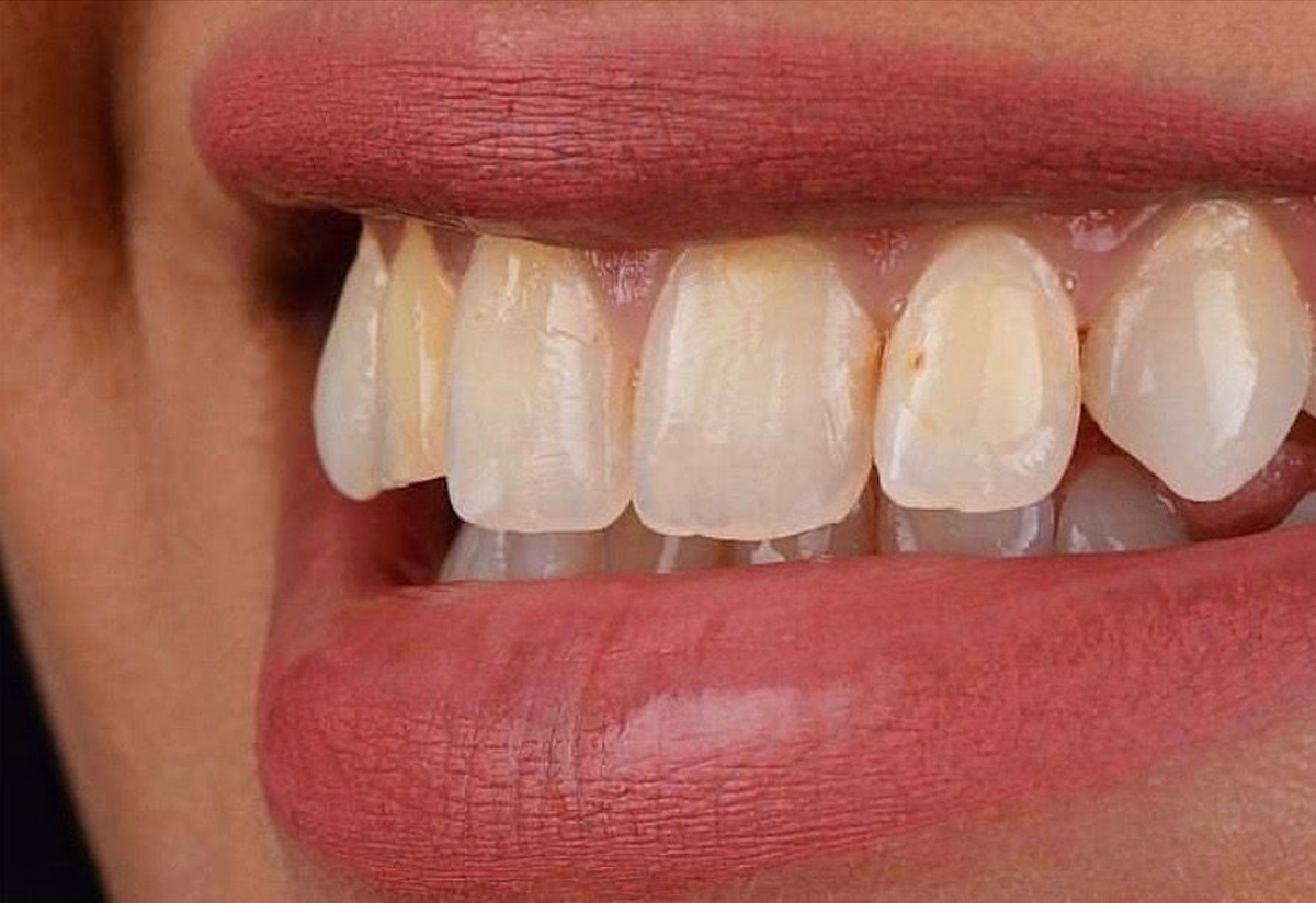 Before: Yellow staining